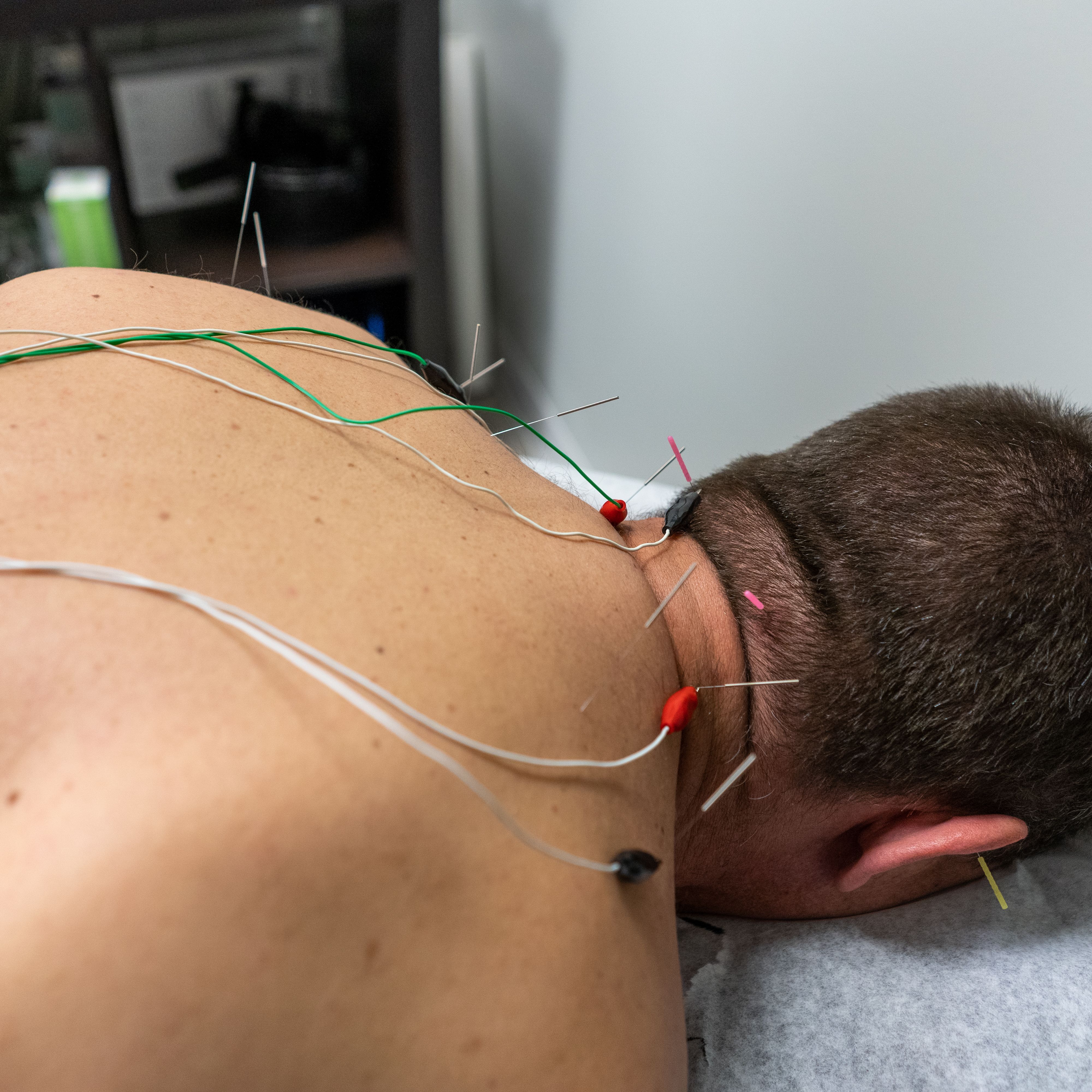 Can Acupuncture Therapy Cure Neck Pain?